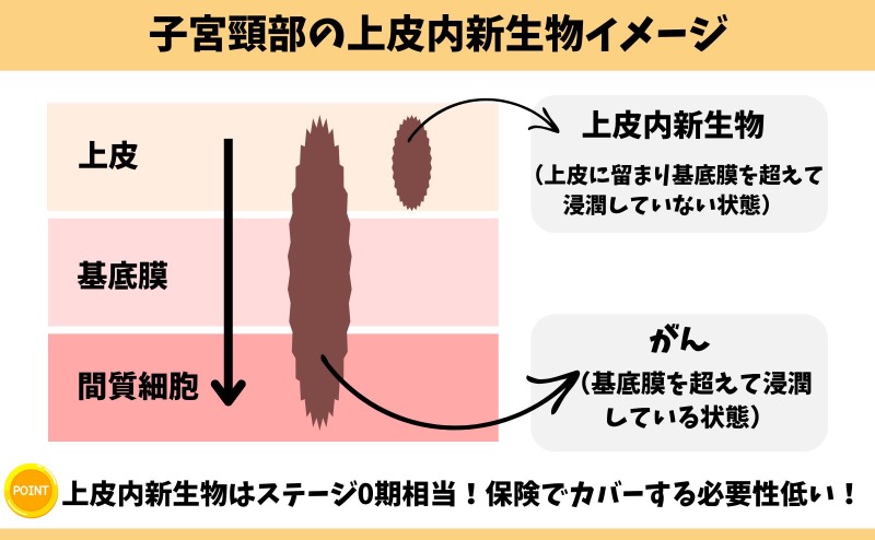 上皮内新生物のイメージ図